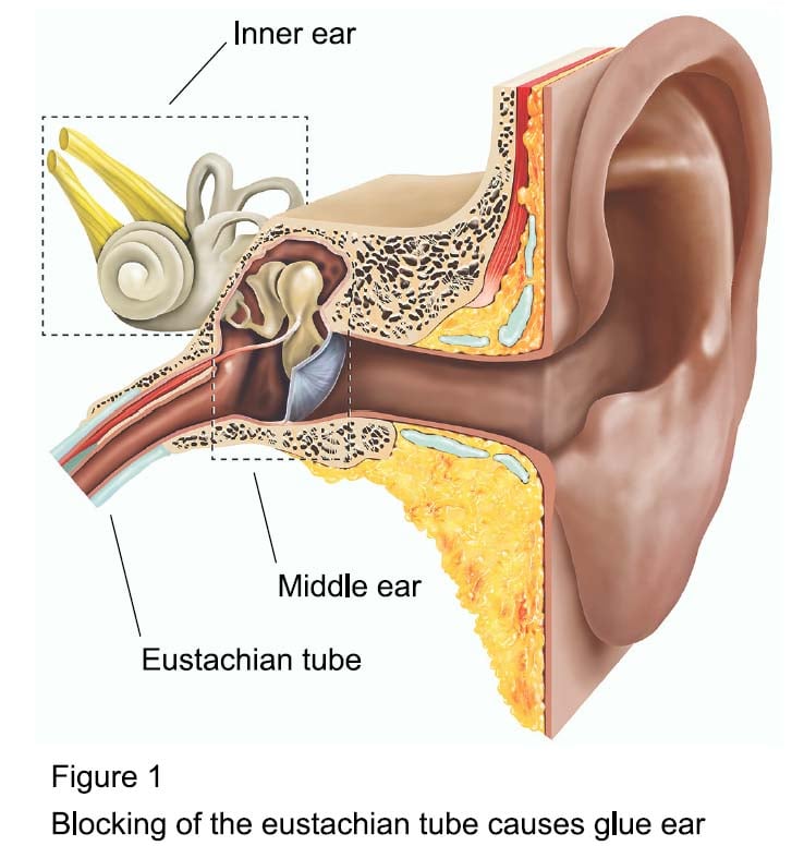 Glue ear