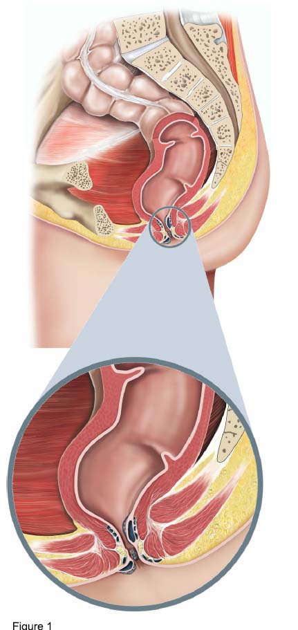 haemorrhoids