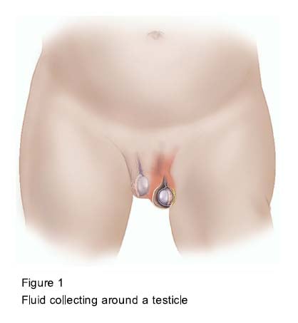 Hydrocele