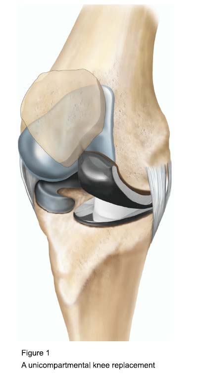 Figure 1 - A unicompartmental knee replacement