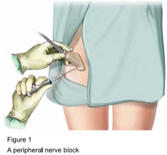 Figure 1 - A peripheral nerve block