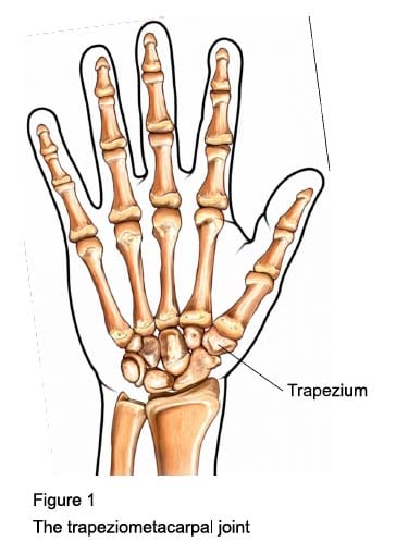 Trapeziectomy